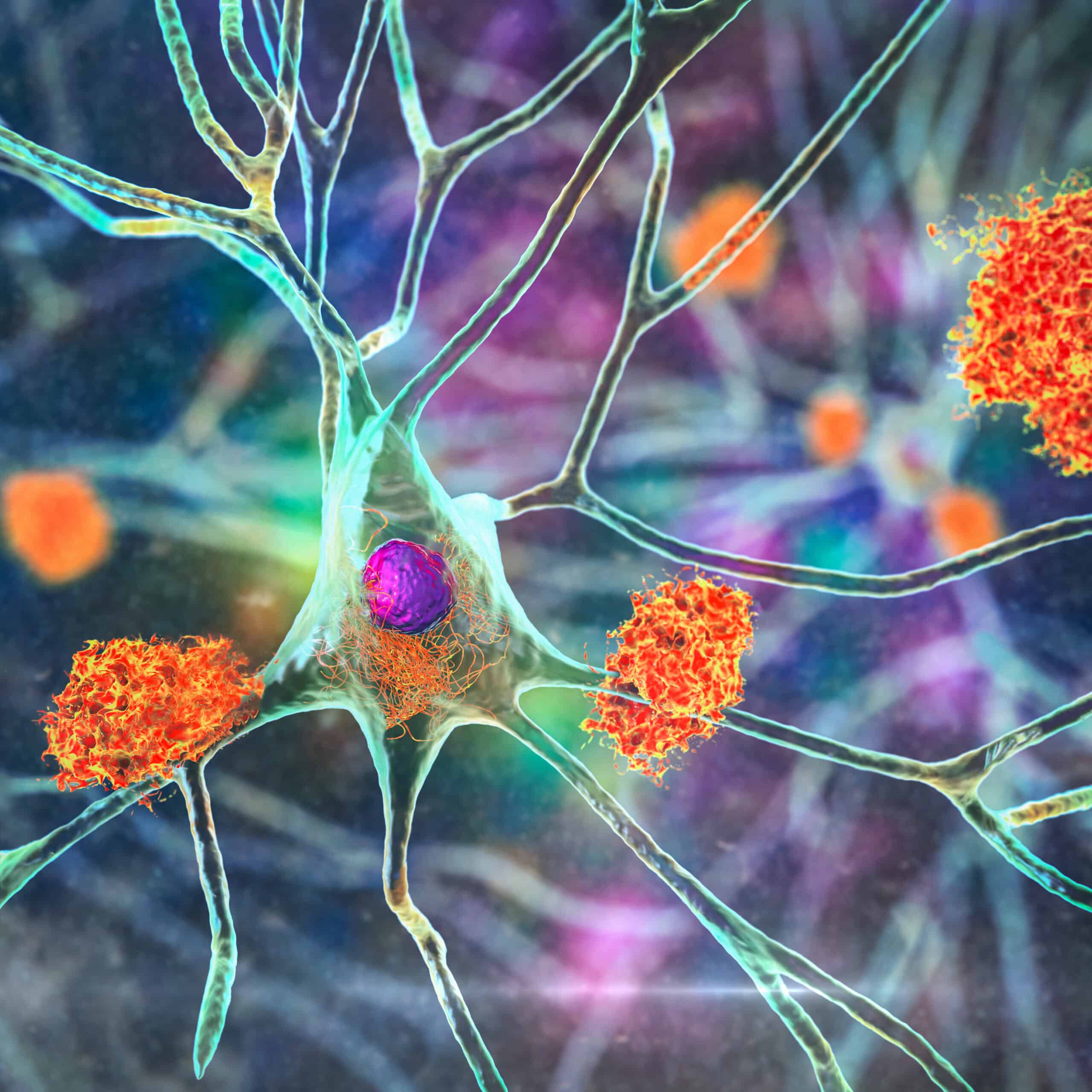 Neurons in Alzheimer's disease. 3D illustration